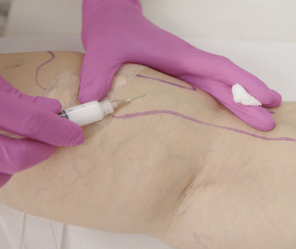 Escleroterapia com Espuma — mapeamento vascular