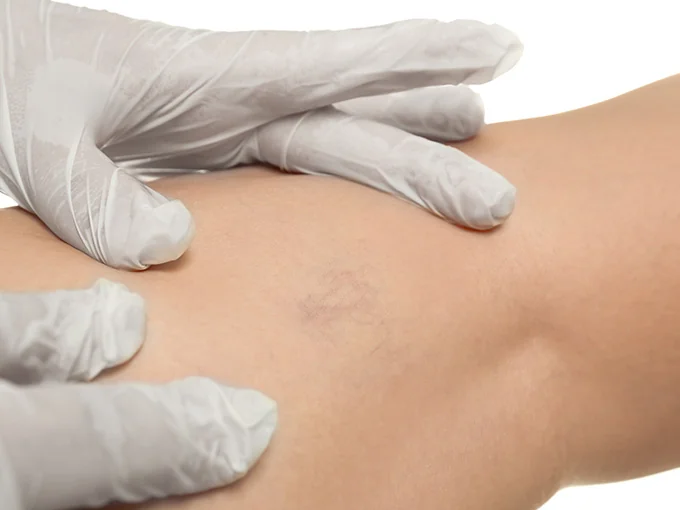 Check-up vascular — exame preventivo