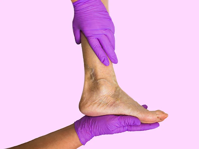 Escleroterapia realizada por cirurgião vascular